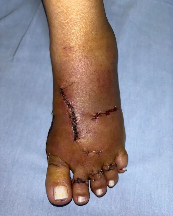 A foot after traditional open surgery, with long stapled incisions and swelling