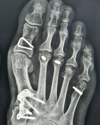 X-ray of a foot after traditional bunion surgery, showing a plate and several screws
